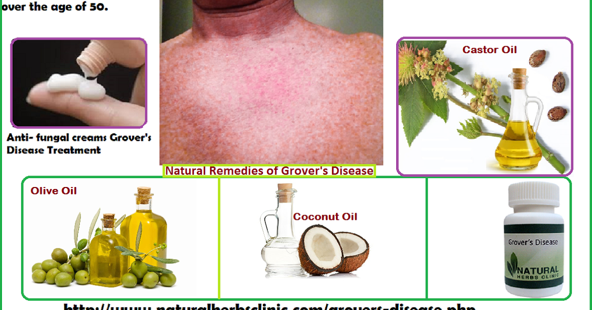 Grover's Disease Natural Remedies