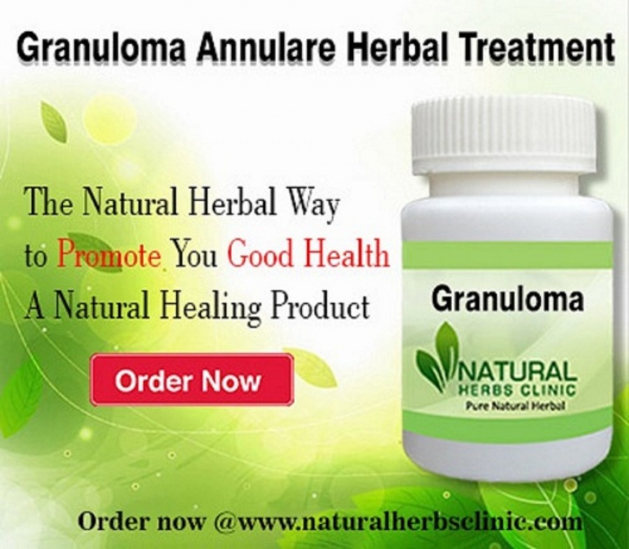 Natural Remedies for Granuloma Annulare Inflammatory Rash Skin Disease