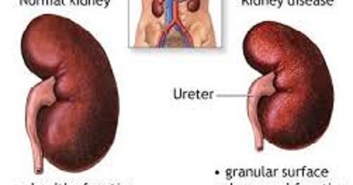 Polycystic Kidney Disease Natural Herbal Treatment