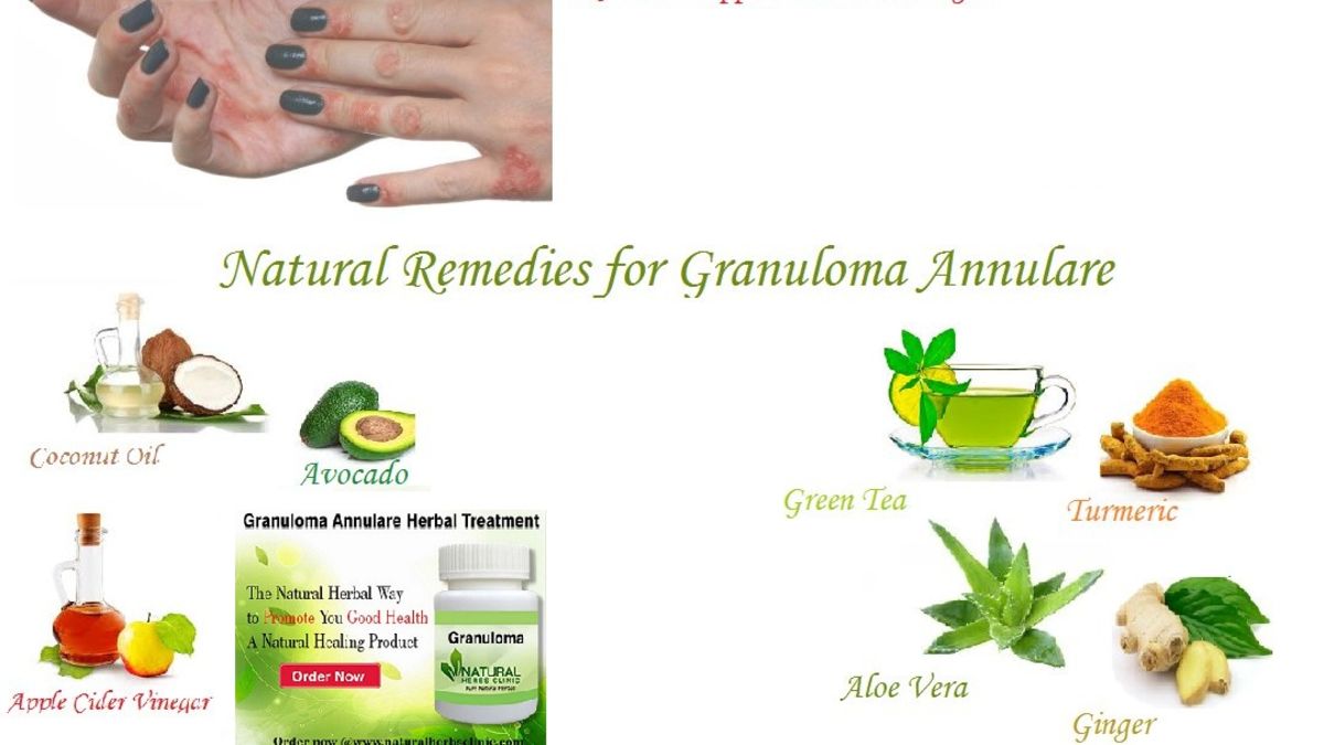 Granuloma Annulare and its Treatment with Natural Herbal Remedies