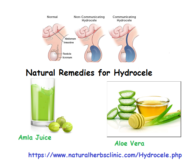 Natural Remedies for Hydrocele Let’s Start with Detail