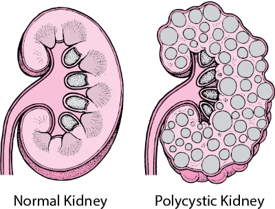 Use Natural Herbal Ingredients in Natural Remedies for Polycystic Kidney Disease