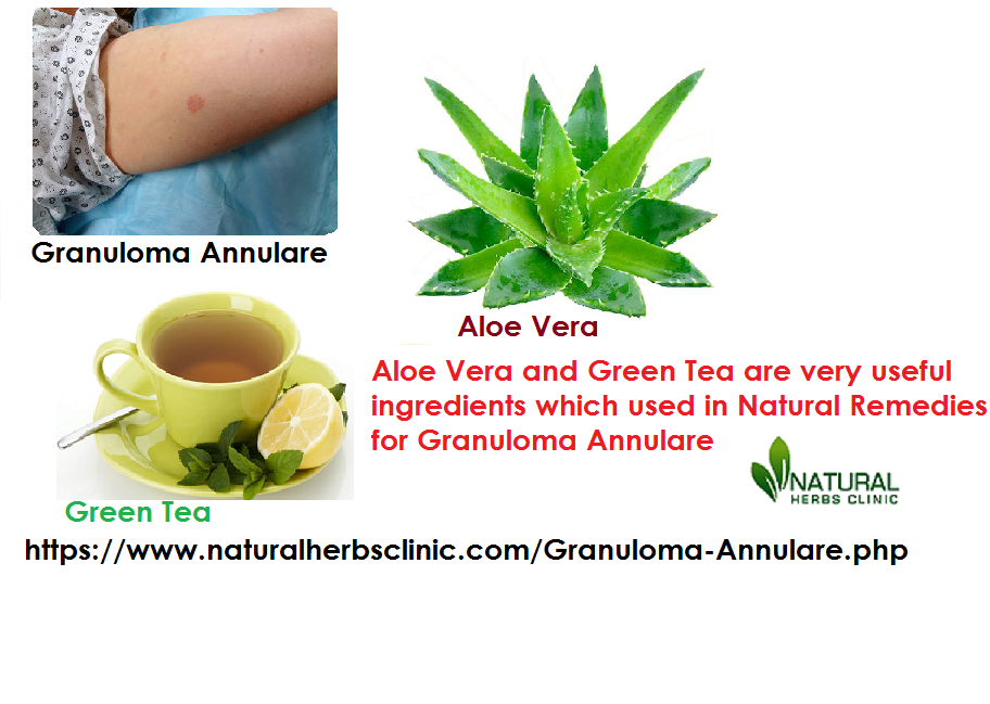 Natural Remedies for Granuloma Annulare, Let's Describes Some