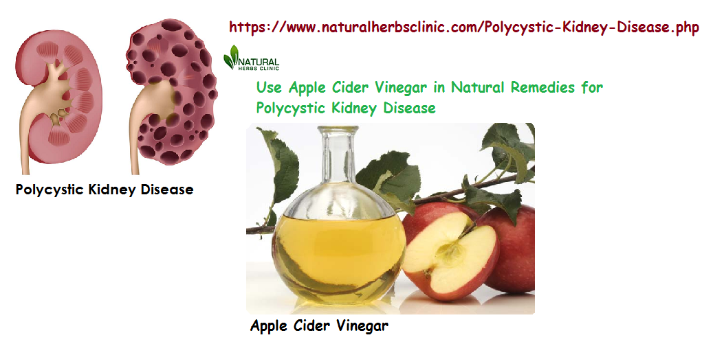 The use of Natural Remedies for Polycystic Kidney Disease can provide Relief