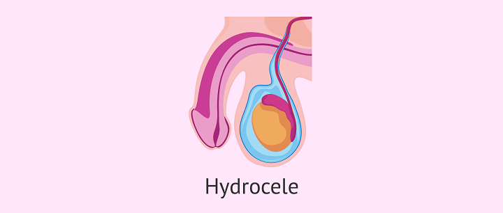 To Get Relief of Swelling Use Natural Remedies for Hydrocele