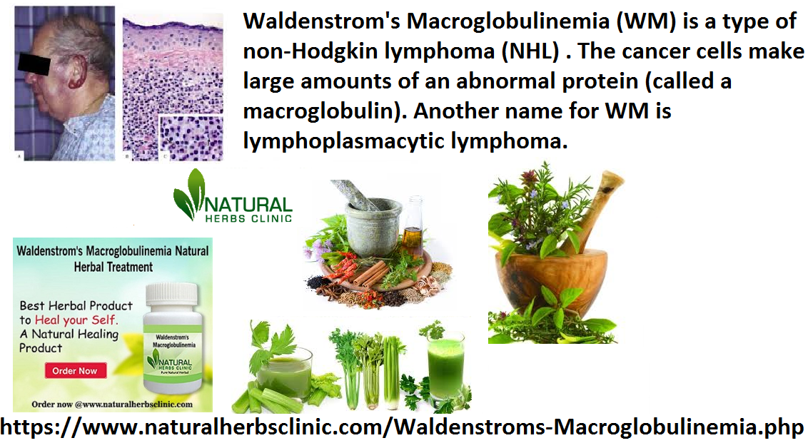 Utilize Natural Remedies for Waldenstrom’s Macroglobulinemia