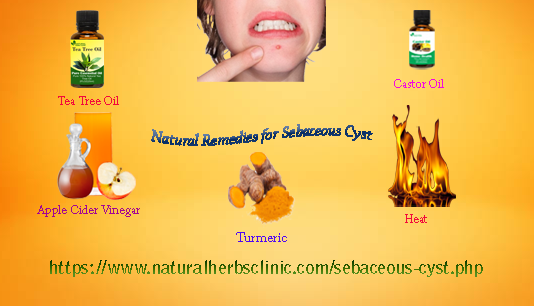 Get Rid of Sebaceous Cyst with the Use of 5 Natural Remedies