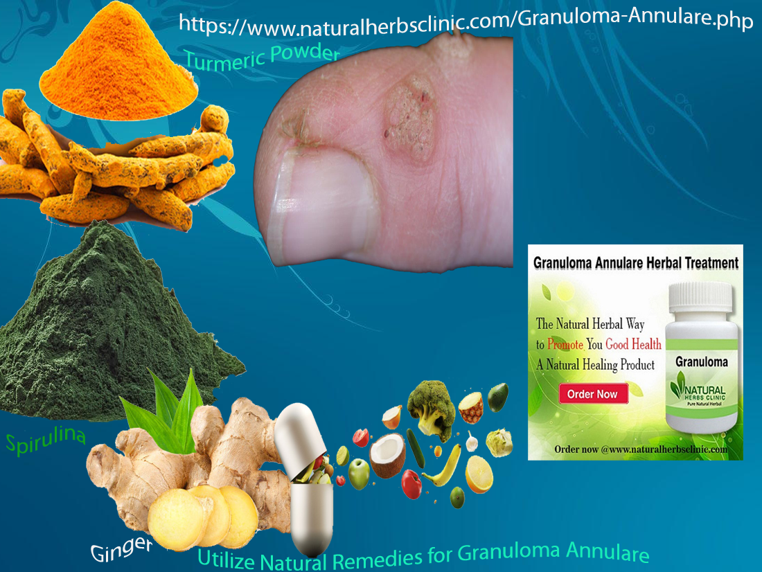 How Might Granuloma Annulare Be Treated with Home Remedies