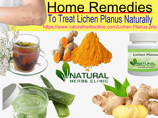 Home Remedies to Treat Lichen Planus Naturally