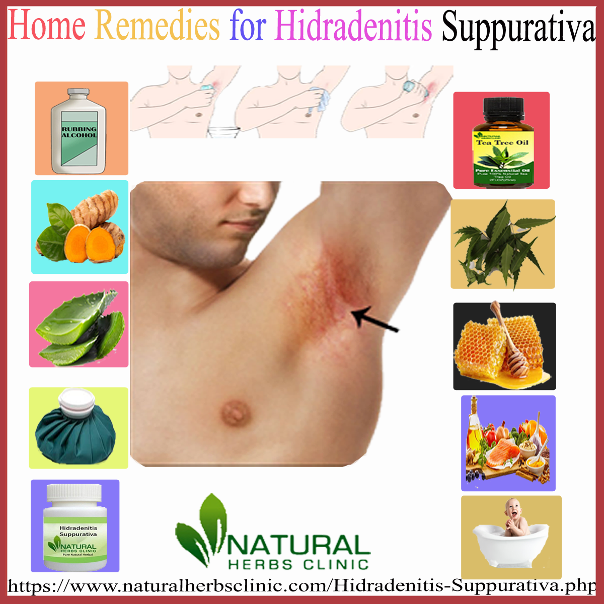 Home Remedies for Hidradenitis Suppurativa