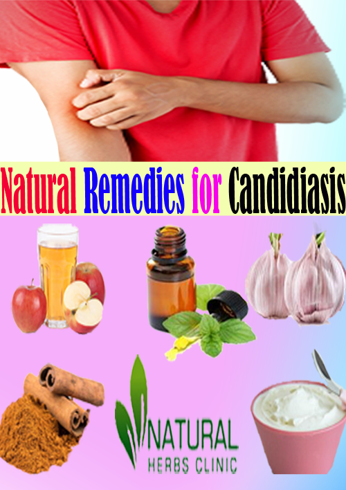 Candidiasis and its Treatment with Natural Remedies