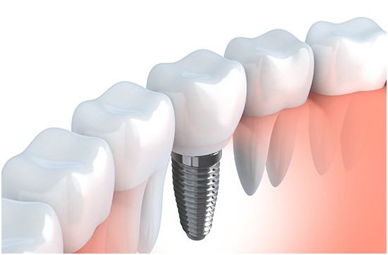 Dental Implants Bala Cynwyd PA (610)-667-6666