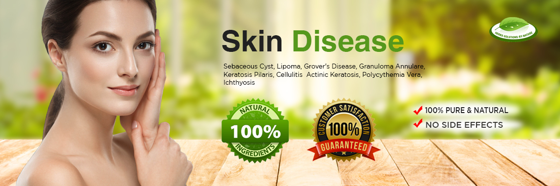 Cure Your Skin Disease with Natural Herbal Treatment