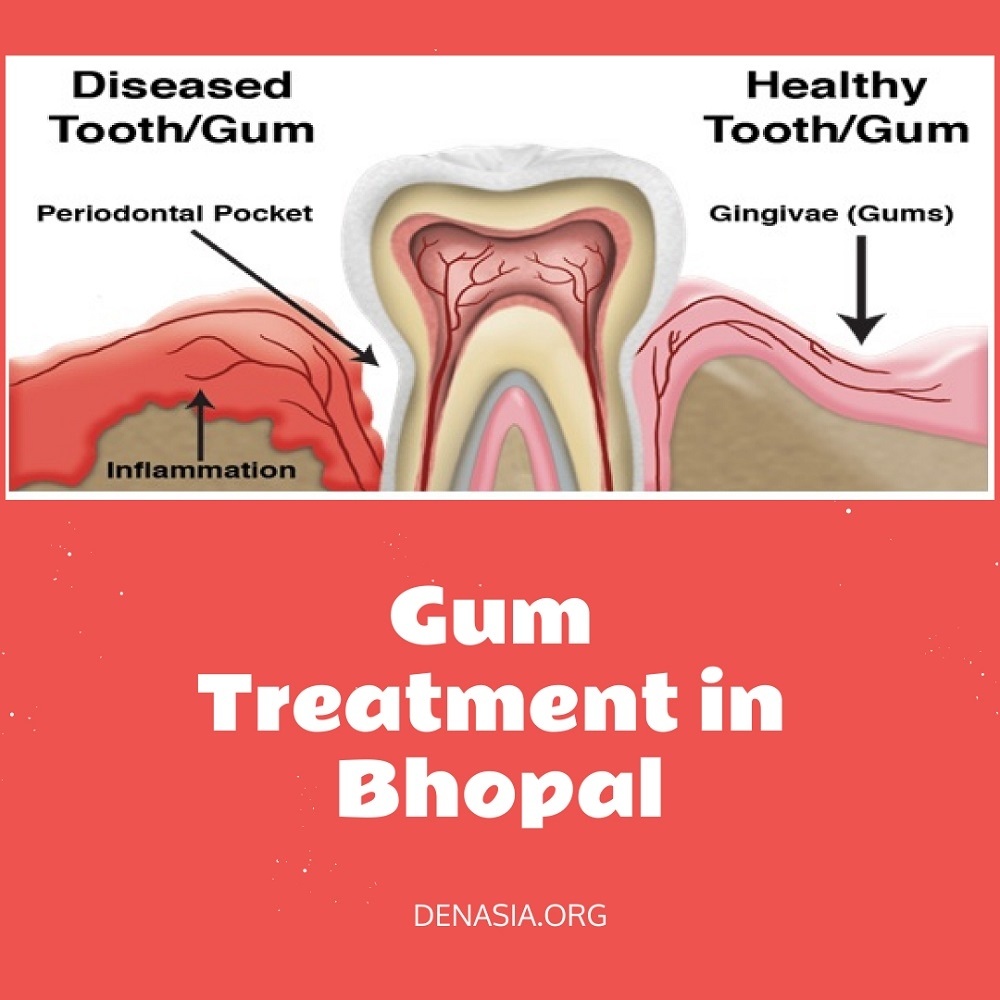 Gum Treatment in Bhopal