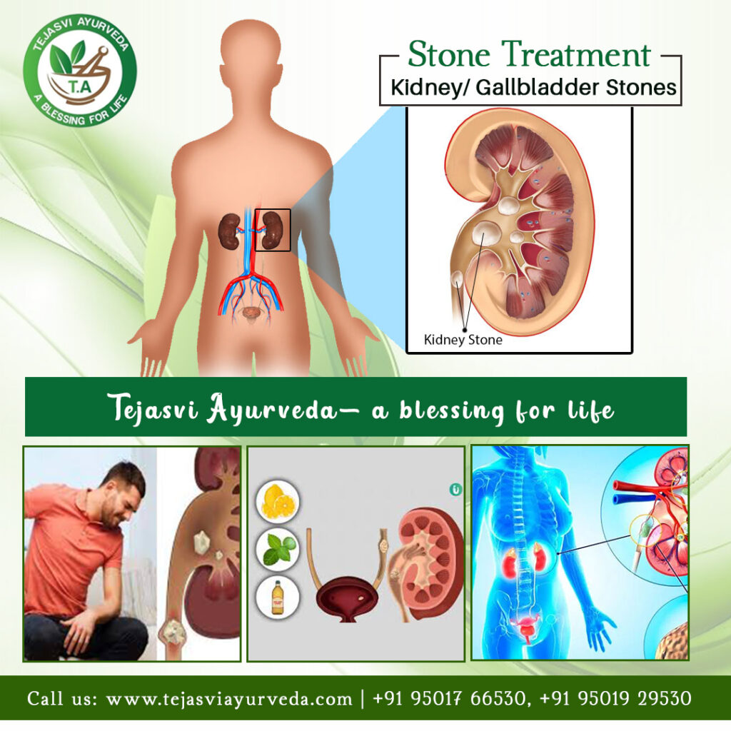 Kidney Specialist Doctor in Chandigarh | Kidney Stone Specialist - Tejasvi Ayurveda
