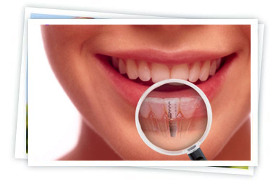 Dental Implants Wilmington NC - Coastal Smiles Family Dentistry