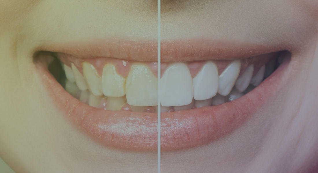 Why should you use professional teeth whitening services?