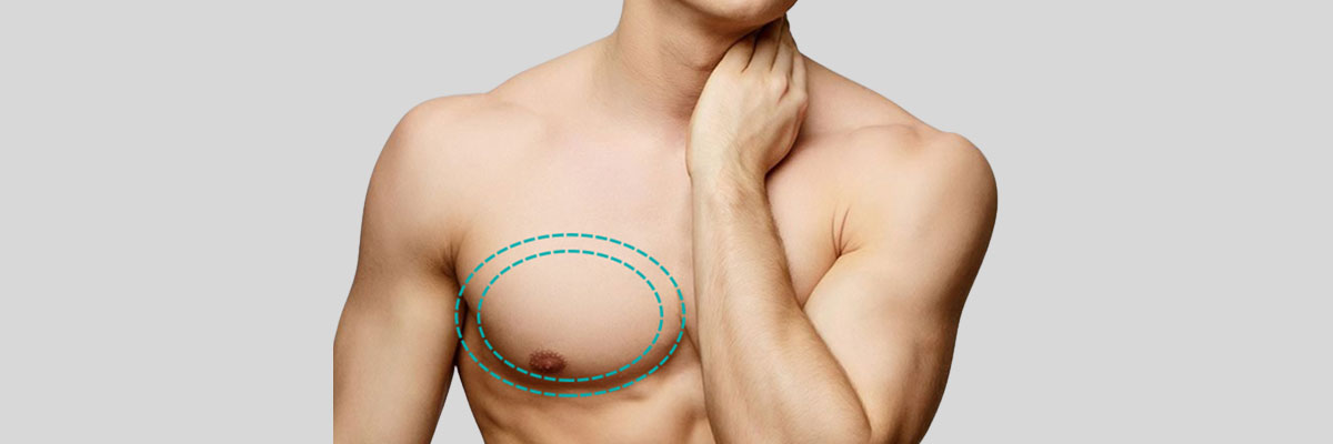 If Embarrassing ‘Male Breasts’ Bother You, Here’s a Solution