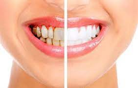What Should You Know Before Considering A Teeth Whitening Treatment In St Albans?