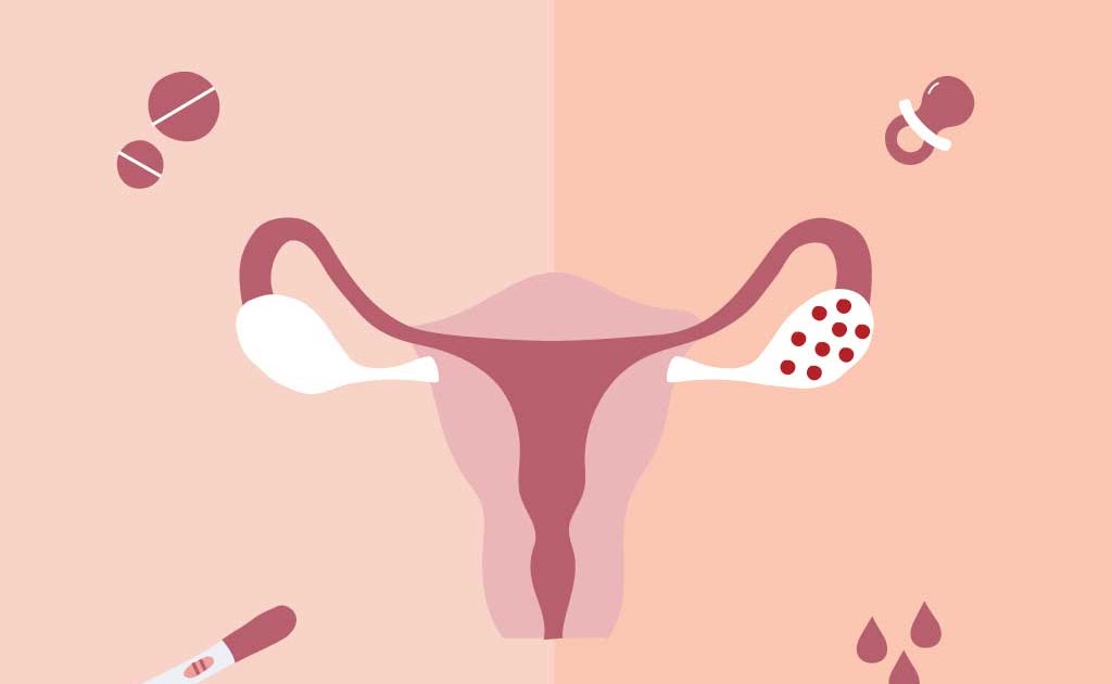 Debunked: 8 Myths About Polycystic Ovary Syndrome