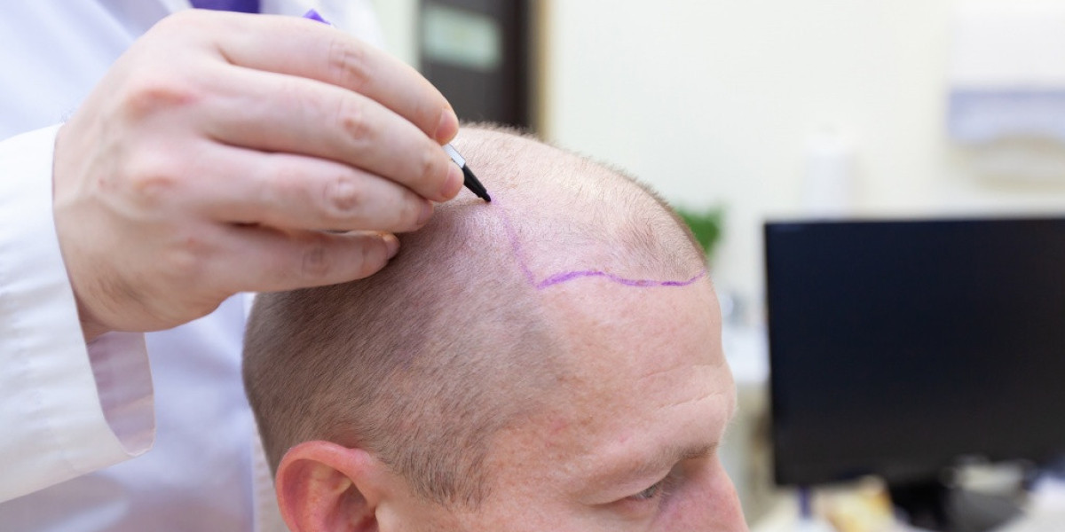 Achieve Natural-Looking Results at Palm Desert Hair Transplant Clinic.