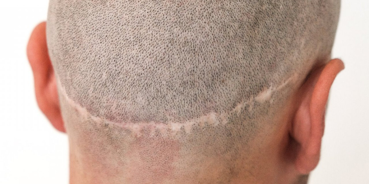 Achieve Natural-Looking Hair: Understanding the Fut Hair Transplantation Procedure.