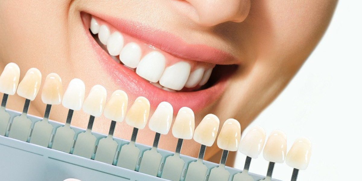 Effective Teeth Whitening Methods in Etobicoke | Which One is Right for You?