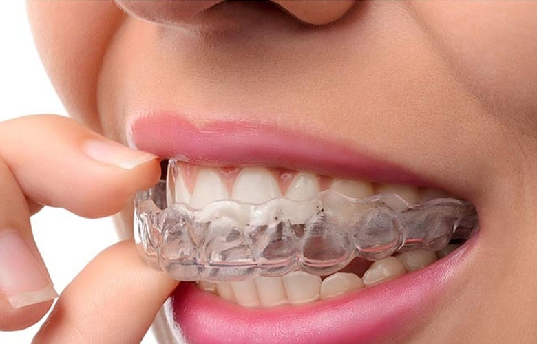 How Orthodontists Customize Invisible Braces For Individuals