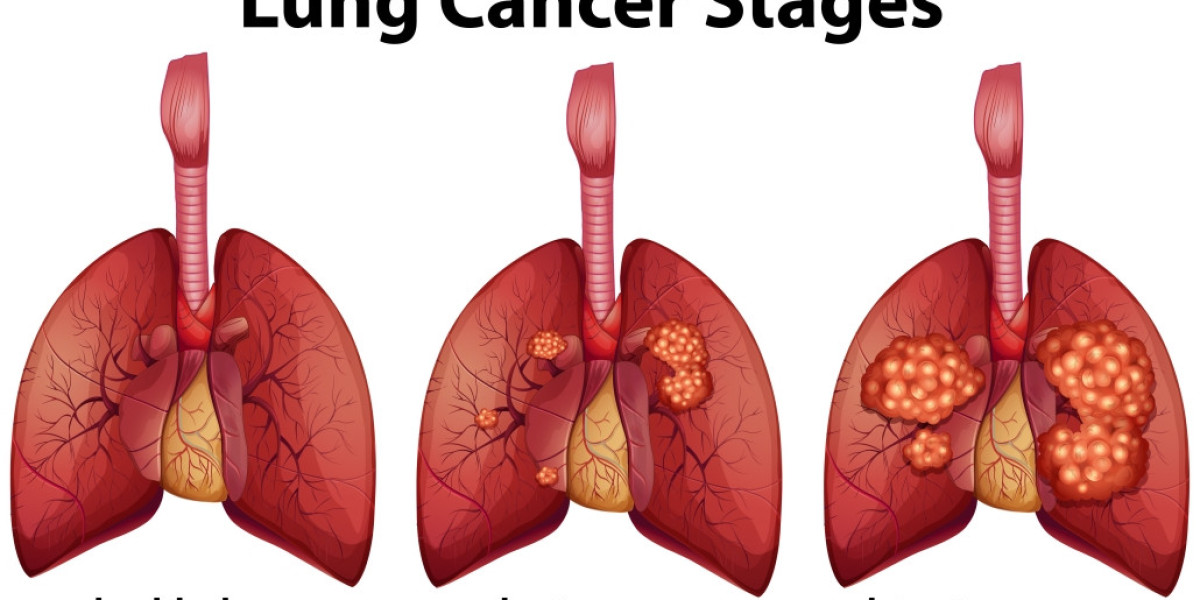 Precision Strikes: Unraveling Targeted Therapy for Cancer, with a Focus on Lung Cancer