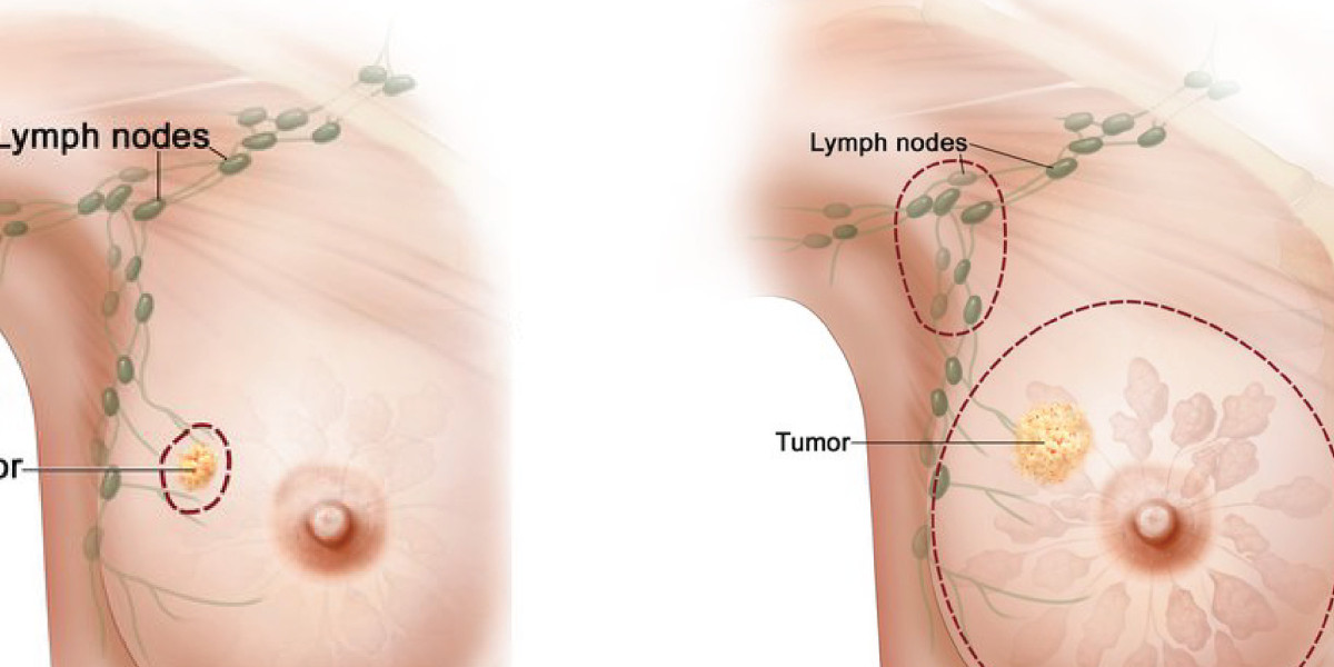 Precision Strikes: Illuminating the Path of Targeted Therapy for Cancer, with a Spotlight on Breast Cancer