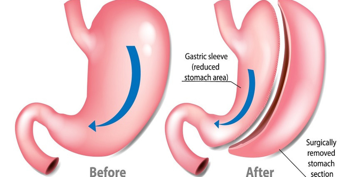 Empower Your Health: A Guide to Gastric Sleeve Surgery