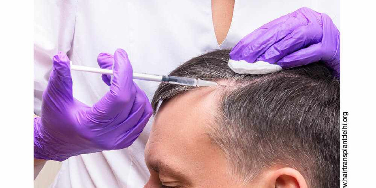 What is Hair Transplant?