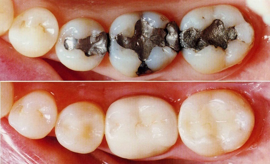 Exploring the Different Types of Tooth-Colored Dental Fillings | TheAmberPost