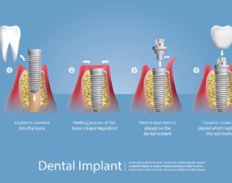 Explain Eligible Patients For Dental Implants Solution 