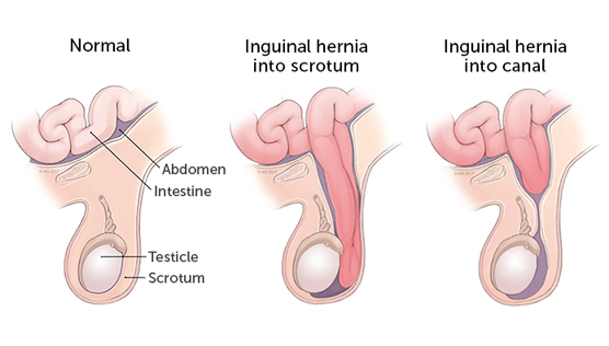 Pediatric Hernia Surgery | Pediatric Hernia Surgeon in Pakistan