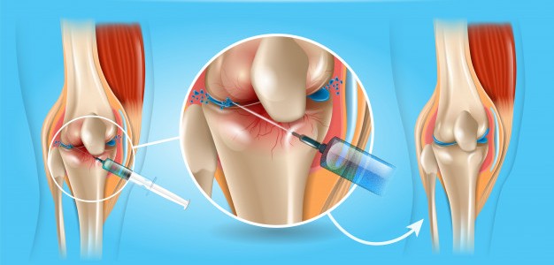 Viscosupplementation – A new way to treat your knee arthritis pain with just an injection! – Dr Sumit Badhwar