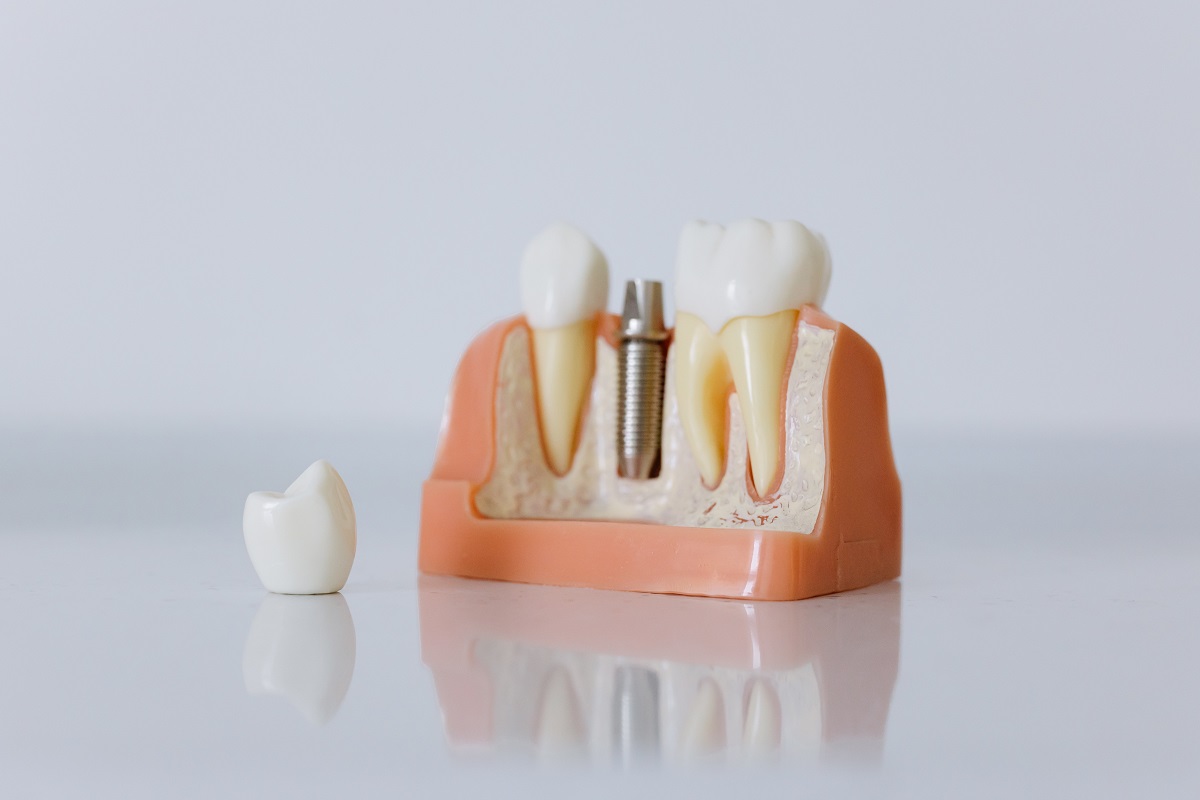 The Importance of Timely Root Canal Treatment in Preston