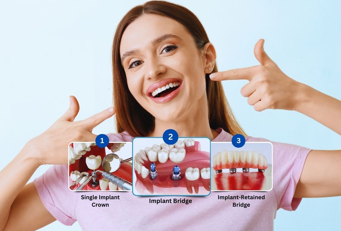 What Are the 3 Types of Dental Implants? | Teethcare