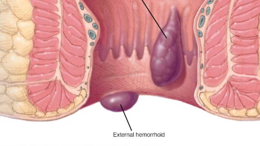 External Hemorrhoid Treatment: Should You Remove or Leave Them? | Dr. Raviram S