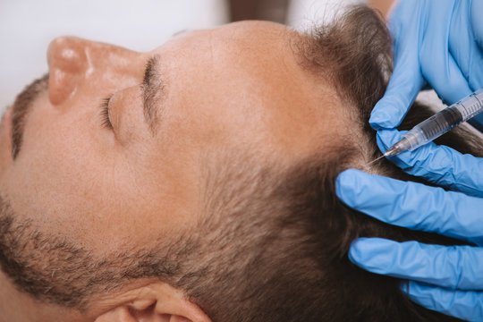 Is PRP the Future of Hair Treatment?