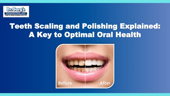 PPT - Teeth Scaling and Polishing Explained A Key to Optimal Oral Health.