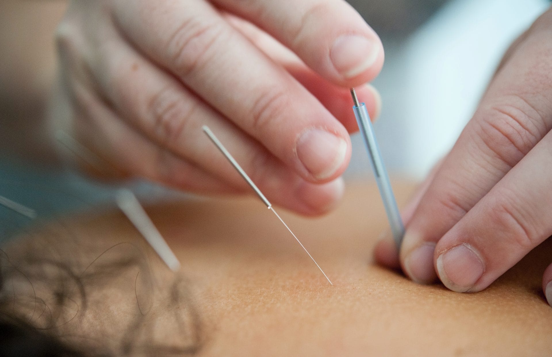 Top Rated Chinese Acupuncture In Brisbane, Milton | Chiropractix