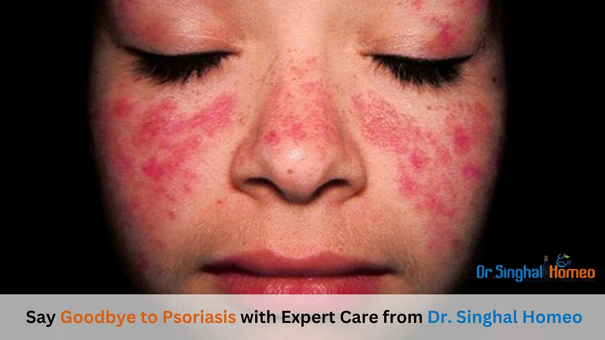 Finding the Best Doctor for Psoriasis Treatment: A Comprehensive Guide | by Dr. Singhal Homeo | Nov, 2024 | Medium