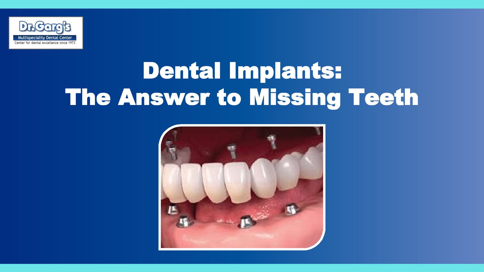 Dental Implants The Answer To Missing Teeth