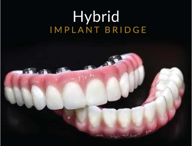 How to Care for Your Dental Implants Properly So That They Last a Lifetime - BizBangBoom