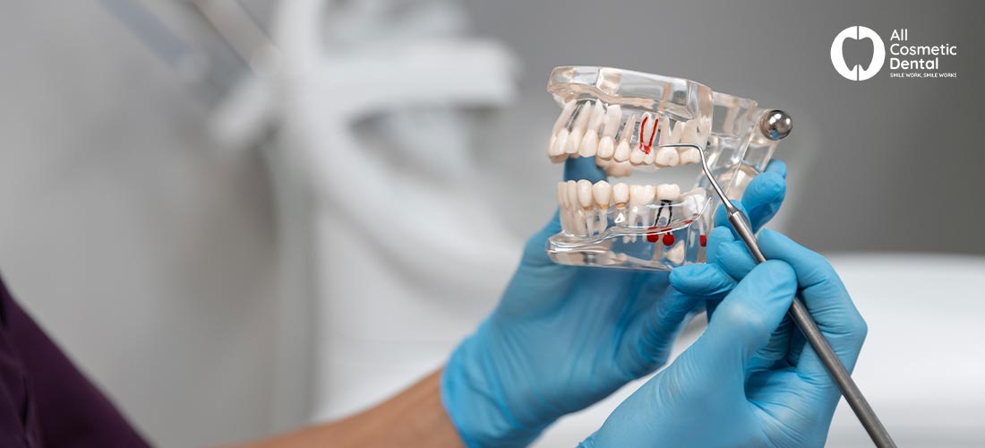 Complete guide to Dental Crowns: Everything you need to know