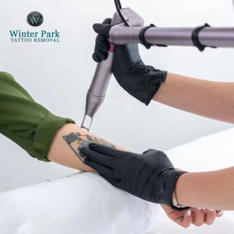 Everything You Need to Know About Tattoo Removal: Methods & Costs